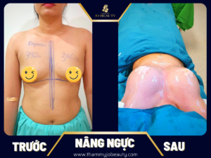 phau-thuat-chinh-sua-nguc-jobeauty
