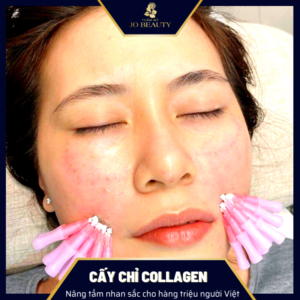 Cay-chi-Collagen