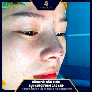 nang-mui-cau-truc-sun-surgiform-jobeauty